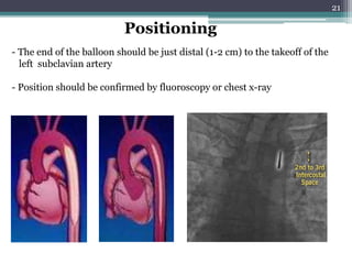 21
- The end of the balloon should be just distal (1-2 cm) to the takeoff of the
left subclavian artery
- Position should be confirmed by fluoroscopy or chest x-ray
Positioning
 