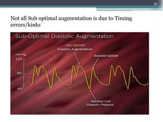 31
Not all Sub optimal augmentation is due to Timing
errors/kinks
 