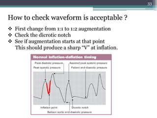 33
How to check waveform is acceptable ?
 First change from 1:1 to 1:2 augmentation
 Check the dicrotic notch
 See if augmentation starts at that point
This should produce a sharp “V” at inflation.
 
