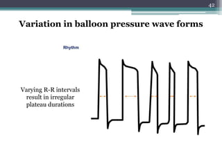 42
Variation in balloon pressure wave forms
Varying R-R intervals
result in irregular
plateau durations
 