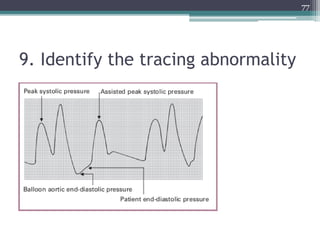 9. Identify the tracing abnormality
77
 