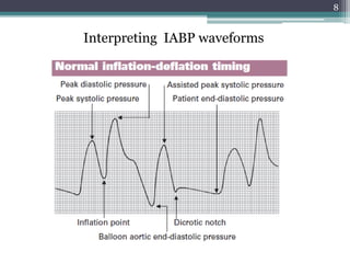 8
Interpreting IABP waveforms
 
