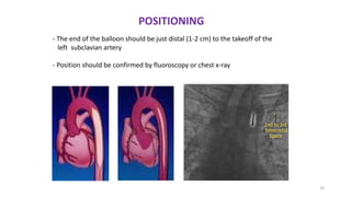 24
- The end of the balloon should be just distal (1-2 cm) to the takeoff of the
left subclavian artery
- Position should be confirmed by fluoroscopy or chest x-ray
POSITIONING
 