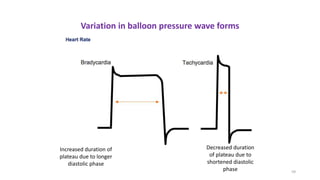 59
Variation in balloon pressure wave forms
Increased duration of
plateau due to longer
diastolic phase
Decreased duration
of plateau due to
shortened diastolic
phase
 