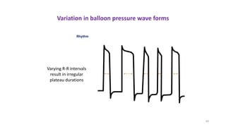 60
Variation in balloon pressure wave forms
Varying R-R intervals
result in irregular
plateau durations
 