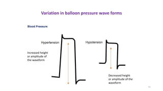 61
Variation in balloon pressure wave forms
Increased height
or amplitude of
the waveform
Decreased height
or amplitude of the
waveform
 