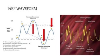 IABP WAVEFORM
• dfgd
 