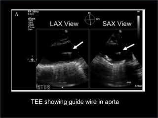 TEE showing guide wire in aorta
 