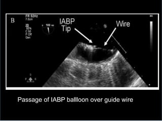 Passage of IABP ballloon over guide wire
 