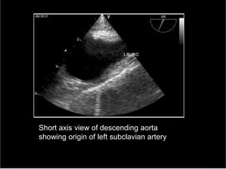 Short axis view of descending aorta
showing origin of left subclavian artery
 