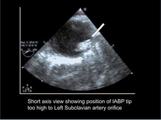Short axis view showing position of IABP tip
too high to Left Subclavian artery orifice
 