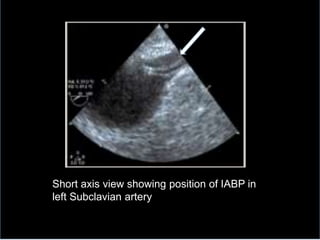 Short axis view showing position of IABP in
left Subclavian artery
 