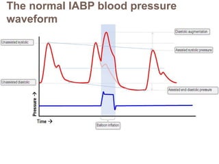 The normal IABP blood pressure
waveform
 