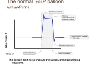 The normal IABP balloon
waveform
The balloon itself has a pressure transducer, and it generates a
waveform.
 