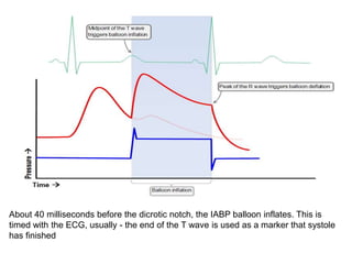 About 40 milliseconds before the dicrotic notch, the IABP balloon inflates. This is
timed with the ECG, usually - the end of the T wave is used as a marker that systole
has finished
 