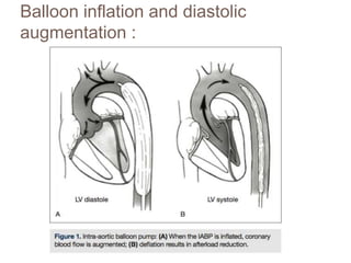 Balloon inflation and diastolic
augmentation :
 
