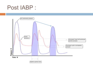 Post IABP :
 