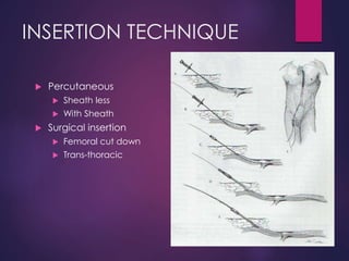 INSERTION TECHNIQUE
 Percutaneous
 Sheath less
 With Sheath
 Surgical insertion
 Femoral cut down
 Trans-thoracic
 