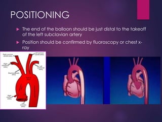 POSITIONING
 The end of the balloon should be just distal to the takeoff
of the left subclavian artery
 Position should be confirmed by fluoroscopy or chest x-
ray
 
