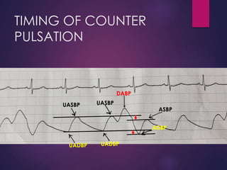 TIMING OF COUNTER
PULSATION
UASBP UASBP
ADBP
UADBPUADBP
ASBP
DABP
 