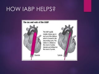 HOW IABP HELPS?
 