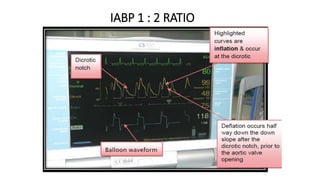 IABP 1 : 2 RATIO
 