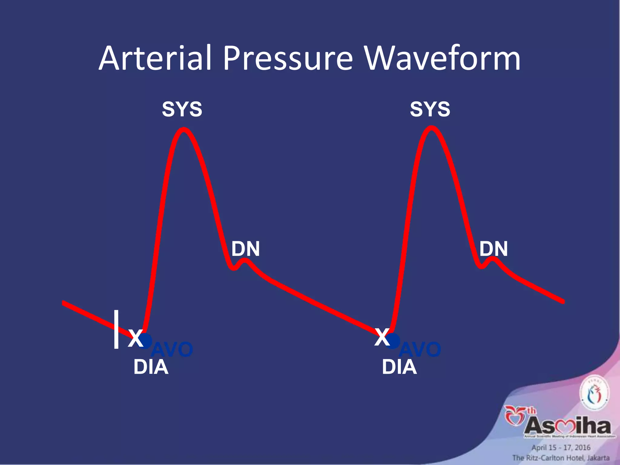Arterial Pressure Waveform
SYS SYS
DN DN
AVO AVOX
DIA DIA
X
 