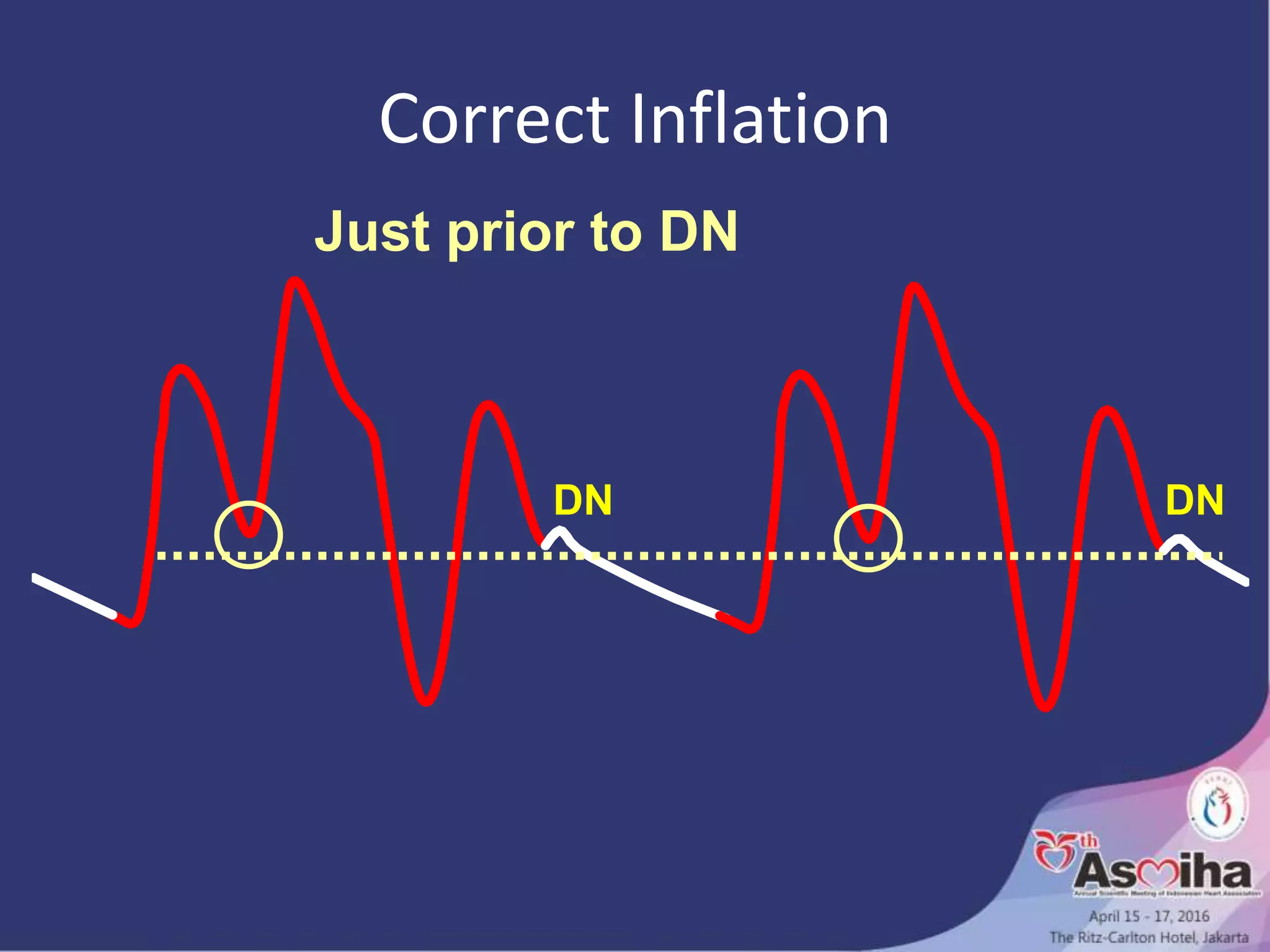 DN DN
Correct Inflation
Just prior to DN
 