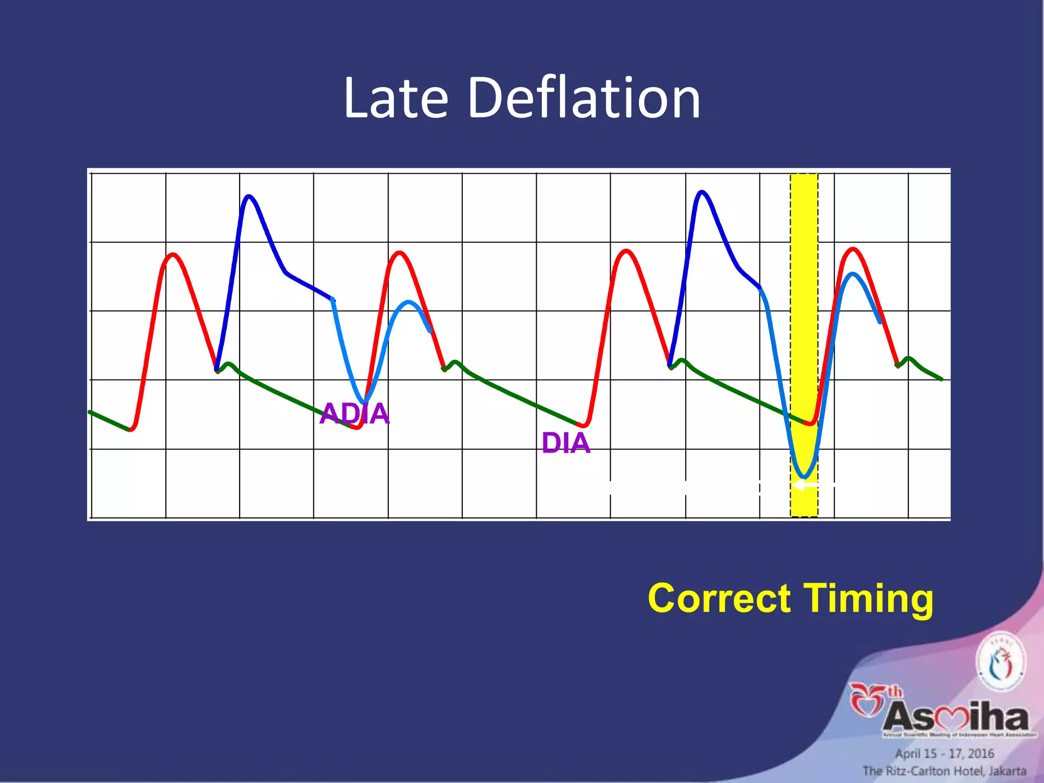 move deflation
ADIA
DIA
Late Deflation
Correct Timing
 
