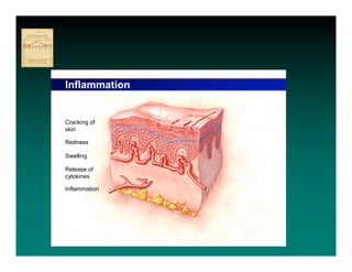 Inflammation


Cracking of
skin

Redness

Swelling

Release of
cytokines

Inflammation
 
