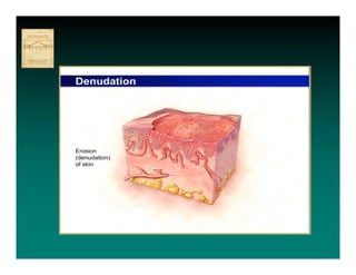 Denudation




Erosion
(denudation)
of skin
 