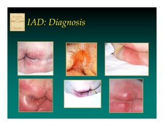 IAD: Diagnosis
 