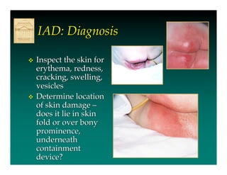 IAD: Diagnosis

   Inspect the skin for
    erythema, redness,
    cracking, swelling,
    vesicles
   Determine location
    of skin damage –
    does it lie in skin
    fold or over bony
    prominence,
    underneath
    containment
    device?
 