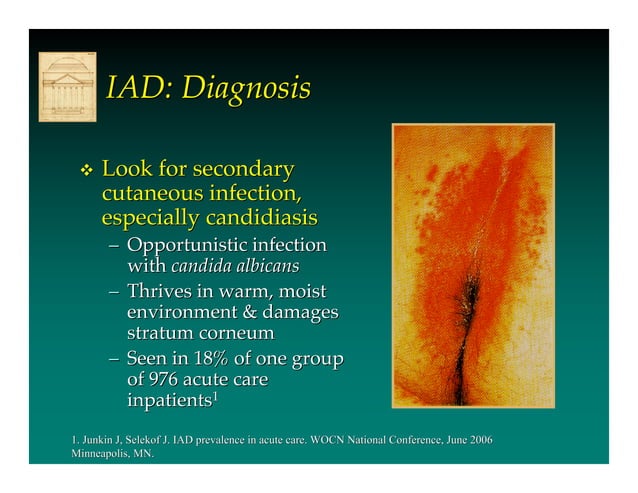 Pee Rash Incontinence Associated Dermatitis by Prof Dr Mikel Gray | PDF