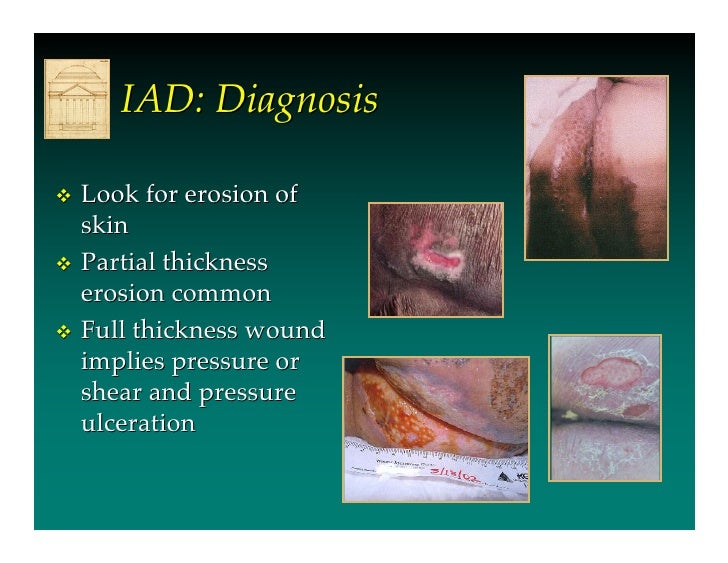 Incontinence Associated Dermatitis by Prof Dr Mikel Gray