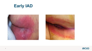 Pee Rash Incontinence assosiated dermatitis pictures.pdf