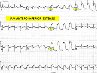 IAM ANTERO-INFERIOR  EXTENSO 