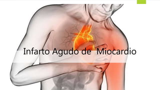 Infarto Agudo de Miocardio
 