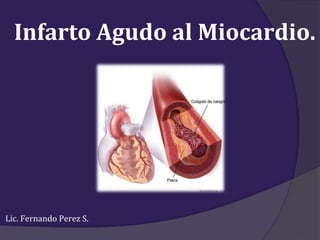 Infarto Agudo al Miocardio.
Lic. Fernando Perez S.
 