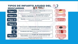 infarto agudo al miocardio con elevacion del st | PPTX