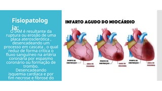 Fisiopatolog
ia:
O IAM é resultante da
ruptura ou erosão de uma
placa aterosclerótica ,
desencadeando um
processo em cascata , o qual
reduz de forma crítica o
fluxo sanguíneo na artéria
coronária por espasmo
coronário ou formação de
trombo.
Desencadeando
isquemia cardíaca e por
fim necrose e fibrose do
tecido.
 