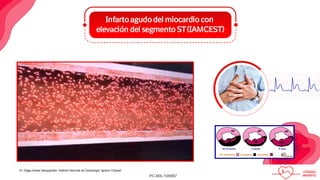 infarto agudo al miocardio con elevacion del st | PDF
