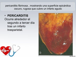 pericarditis fibrinosa , mostrando una superficie epicárdica
oscuro, rugosa que cubre un infarto agudo
• PERICARDITIS
Ocurre alrededor el
segundo a tercer día
tras un infarto
trasparietal.
 