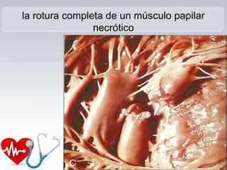 la rotura completa de un músculo papilar
necrótico
 