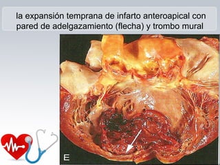 la expansión temprana de infarto anteroapical con
pared de adelgazamiento (flecha) y trombo mural
 