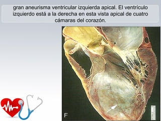 gran aneurisma ventricular izquierda apical. El ventrículo
izquierdo está a la derecha en esta vista apical de cuatro
cámaras del corazón.
 