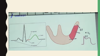 INFARTO AGUDO DE MIOCARDIO CON ELEVACION DEL ST Y SIN ELEVACION DEL ST ...
