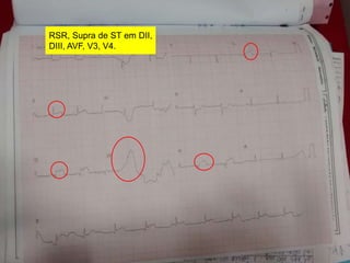 RSR, Supra de ST em DII, 
DIII, AVF, V3, V4. 
 