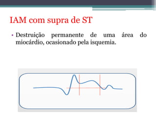IAM com supra de ST 
• Destruição permanente de uma área do 
miocárdio, ocasionado pela isquemia. 
 