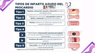 Infarto Agudo al miocardio con elevación ST | PPTX